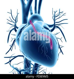 Un pontage cardiaque. Illustration d'ordinateur d'un coeur qui a eu un blocage des artères coronaires traitée par pontage aortocoronarien par greffe (PACG). Les artères coronaires sont les petits vaisseaux sanguins vu courir sur la surface externe du cœur. Ils fournissent le sang oxygéné pour garder le muscle cardiaque, de pompage et d'un blocage peut entraîner une crise cardiaque mortelle. La solution est de récolter les artères des ailleurs dans le corps et les utiliser pour contourner le blocage. Un greffon est vu en cours d'exécution à partir de l'aorte, l'artère principale, retour à des artères coronaires. Banque D'Images