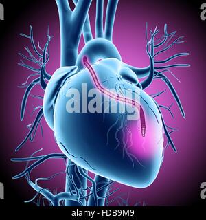 Un pontage cardiaque. Illustration d'ordinateur d'un coeur qui a eu un blocage des artères coronaires traitée par pontage aortocoronarien par greffe (PACG). Les artères coronaires sont les petits vaisseaux sanguins vu courir sur la surface externe du cœur. Ils fournissent le sang oxygéné pour garder le muscle cardiaque, de pompage et d'un blocage peut entraîner une crise cardiaque mortelle. La solution est de récolter les artères des ailleurs dans le corps et les utiliser pour contourner le blocage. Un greffon est vu en cours d'exécution à partir de l'aorte, l'artère principale, retour à des artères coronaires. Banque D'Images