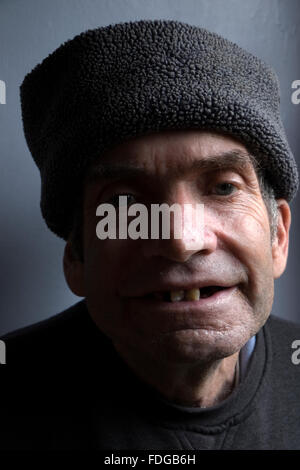 Homme avec des problèmes de santé de métal vivant avec un cancer de la gorge inopérable Banque D'Images