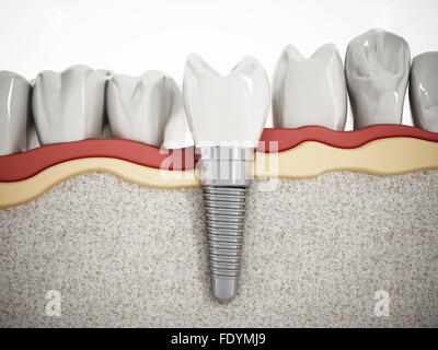 Illustration de dents montrant la structure d'implant dentaire Banque D'Images