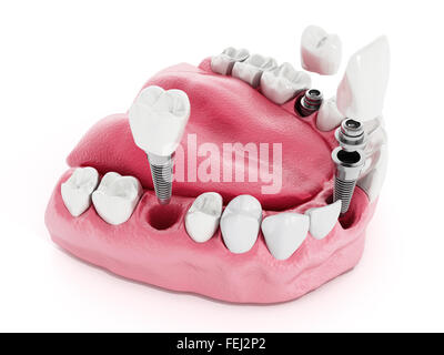 Illustration de dents montrant la structure d'implant dentaire Banque D'Images