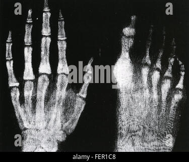 WILHELM RONTGEN (1845-1923) Physicien allemand qui a découvert les rayons x. L'un de ses 1896 photos montrant une main gauche et le pied droit. Banque D'Images