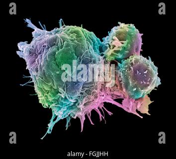 Les lymphocytes T et les cellules du cancer. Couleur de l'analyse des électrons Microphotographie (SEM) de cellules lymphocytes T (cellules rondes plus petites) Banque D'Images