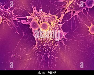 Les lymphocytes T et les cellules du cancer. Couleur de l'analyse des électrons Microphotographie (SEM) de cellules lymphocytes T (cellules rondes plus petites) Banque D'Images