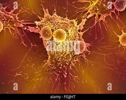 Les lymphocytes T et les cellules du cancer. Couleur de l'analyse des électrons Microphotographie (SEM) de cellules lymphocytes T (cellules rondes plus petites) Banque D'Images