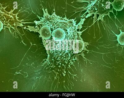 Les lymphocytes T et les cellules du cancer. Couleur de l'analyse des électrons Microphotographie (SEM) de cellules lymphocytes T (cellules rondes plus petites) Banque D'Images