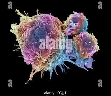 Les lymphocytes T et les cellules du cancer. Couleur de l'analyse des électrons Microphotographie (SEM) de cellules lymphocytes T (cellules rondes plus petites) Banque D'Images