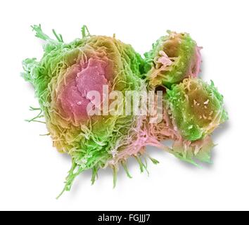 Les lymphocytes T et les cellules du cancer. Couleur de l'analyse des électrons Microphotographie (SEM) de cellules lymphocytes T (cellules rondes plus petites) Banque D'Images