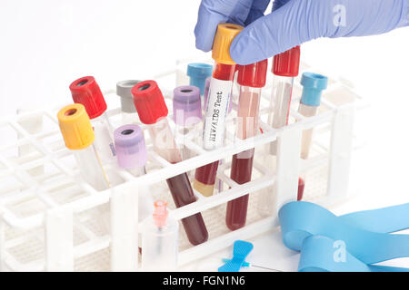 Analyse de sang VIH collection tube sélectionné par technicien de laboratoire. Les étiquettes et le document sont fictifs et créé par la photographie Banque D'Images