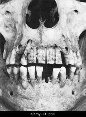 Médecine, dentisterie, crâne de la période baroque avec des prothèses dentaires au lieu des incisives supérieures, du champ de tombe à Berlin, de: 'Medizin Aktuell', numéro 12, 1987, droits additionnels-Clearences-non disponible Banque D'Images