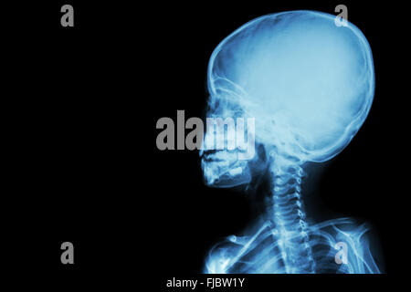 Film x-ray le crâne et corps d'enfant ( zone vide du côté gauche ) Banque D'Images