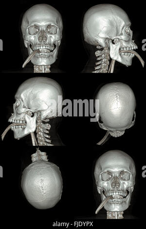 X-ray image de la tomodensitométrie du crâne 3D Banque D'Images