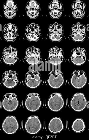 La recherche dans la médecine. CT scan du patient. Banque D'Images