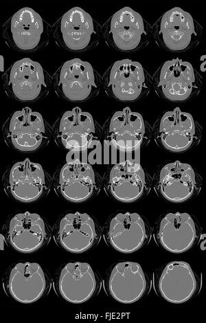 La recherche dans la médecine. CT scan du patient. Banque D'Images