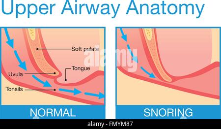 L'obstruction des voies aériennes dans l'anatomie humaine et normale du coucher ont le ronflement. Illustration de Vecteur