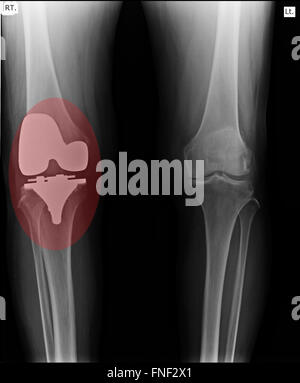 Remplacement total du genou avec x-ray image sur fond noir Banque D'Images