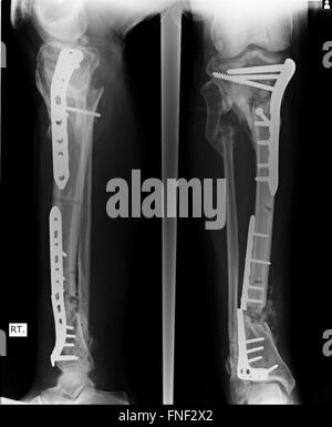 L'avant-bras, coude Fracture x-rays image montrant la fixation de plaque et vis Banque D'Images