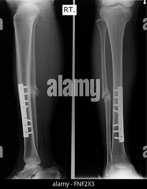 L'avant-bras, coude Fracture x-rays image montrant la fixation de plaque et vis Banque D'Images