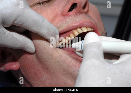 Un dentiste de retirer la plaque et le tartre des dents d'un homme de prévenir les caries et autres problèmes d'peridontal Banque D'Images