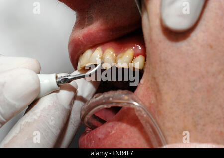 Un dentiste de retirer la plaque et le tartre des dents d'un homme de prévenir les caries et autres problèmes d'peridontal Banque D'Images