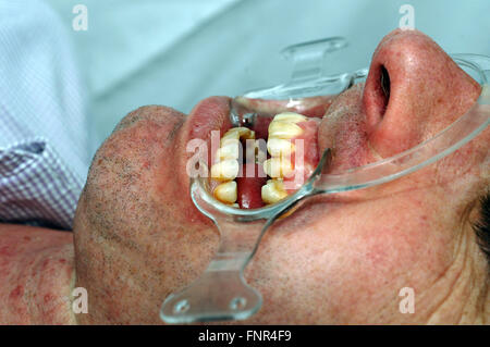 Un dentiste de retirer la plaque et le tartre des dents d'un homme de prévenir les caries et autres problèmes d'peridontal Banque D'Images