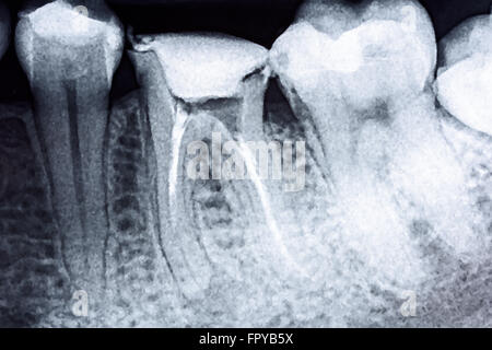 L'obturation complète de systèmes de traitement de canal sur dent X-Ray Banque D'Images