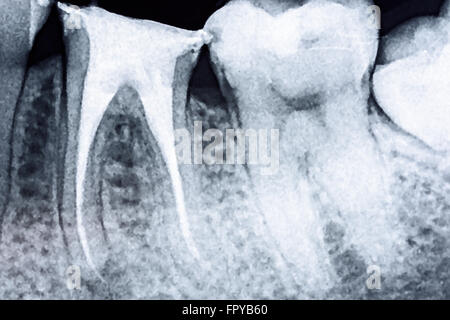 L'obturation complète de systèmes de traitement de canal sur dent X-Ray Banque D'Images