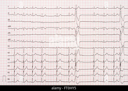 Extrasystole sur l'enregistrement de l'électrocardiogramme 12 dérivations Paper Banque D'Images