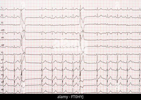 Extrasystole sur l'enregistrement de l'électrocardiogramme 12 dérivations Paper Banque D'Images