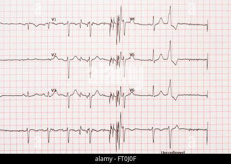 Extrasystole sur l'enregistrement de l'électrocardiogramme 12 dérivations Paper Banque D'Images