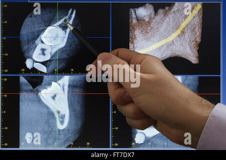 Médecin indiquant une dent de sagesse sur X-ray computed tomography Banque D'Images