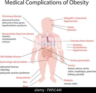 Illustration de complication médicale de l'obésité Illustration de Vecteur