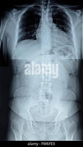 X-ray de la colonne vertébrale Banque D'Images