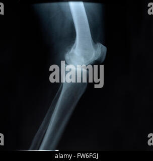 X-ray photo montrant le genou Banque D'Images