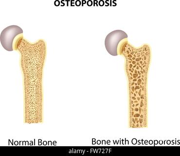 Illustration de l'os de la hanche. l'os normal et l'os à l'ostéoporose Illustration de Vecteur