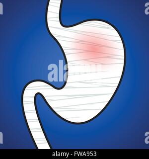 Les blessures de l'estomac sur un fond bleu. L'illustration. Illustration de Vecteur