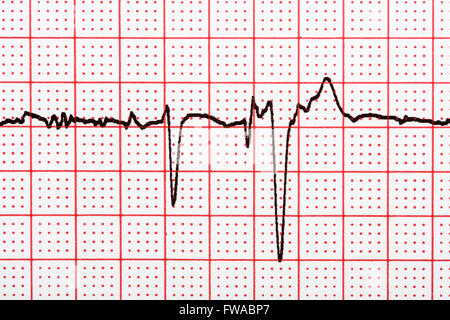 Extrasystole sur l'enregistrement de l'électrocardiogramme 12 dérivations Paper Banque D'Images