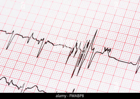 Extrasystole sur l'enregistrement de l'électrocardiogramme 12 dérivations Paper Banque D'Images