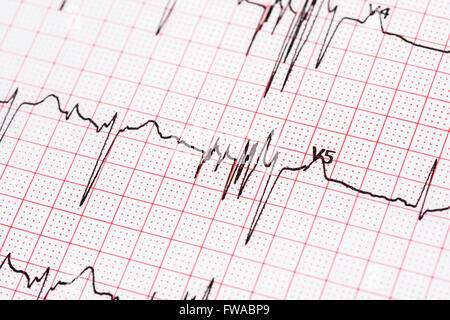 Extrasystole sur l'enregistrement de l'électrocardiogramme 12 dérivations Paper Banque D'Images