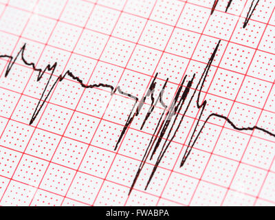 Extrasystole sur l'enregistrement de l'électrocardiogramme 12 dérivations Paper Banque D'Images