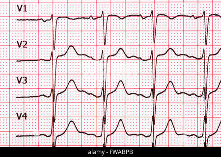 Extrasystole sur l'enregistrement de l'électrocardiogramme 12 dérivations Paper Banque D'Images