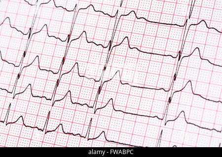 Extrasystole sur l'enregistrement de l'électrocardiogramme 12 dérivations Paper Banque D'Images