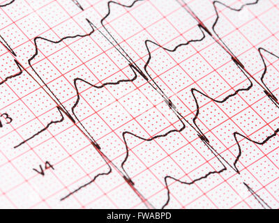 Extrasystole sur l'enregistrement de l'électrocardiogramme 12 dérivations Paper Banque D'Images