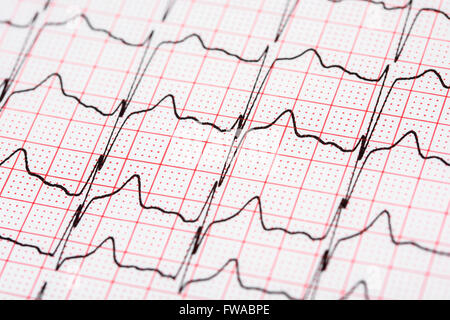 Extrasystole sur l'enregistrement de l'électrocardiogramme 12 dérivations Paper Banque D'Images