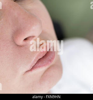 L'herpès sur les lèvres de la jeune femme, Close up Banque D'Images