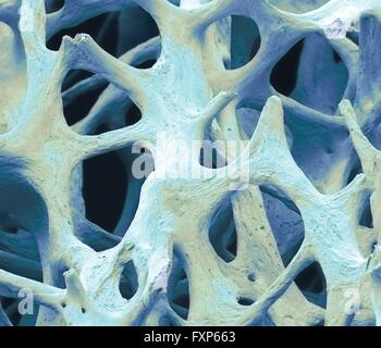 Le tissu osseux. Couleur de l'analyse des électrons Microphotographie (SEM) d'os spongieux (spongieux) os. Le tissu osseux peut être soit corticales (compact) ou d'os spongieux. L'os cortical fait généralement de l'extérieur de l'os, tandis que l'os spongieux se trouve dans l'intérieur. L'os spongieux se caractérise par un nid d'arrangement, comprenant un réseau de trabécules (forme de tige tissu). Ces structures offrent l'appui et la force de l'os. Les espaces au sein de ces tissus contiennent de la moelle osseuse (pas vu), une substance formant le sang. Grossissement : x40 lors de l'impression de 10 cm de largeur. Banque D'Images