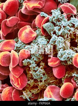 Globules rouges et les plaquettes. Couleur de l'analyse microscope Microphotographie (SEM) des érythrocytes (globules rouges) et un agrégat plaquettaire (bleu). Les plaquettes sont des fragments de cellules de sang blanches qui, dans des circonstances normales, sont de petite taille et de forme biconcave. Cependant, s'il y a une rupture de la surface d'un vaisseau sanguin, les plaquettes sont en contact avec des molécules qu'elles ne sont pas utilisées pour devenir et activé. Ils deviennent informe, en forme, avec de longues projections (pseudopodes) qui leur permettent d'adhérer à d'autres cellules et l'autre, formant un caillot. Agrandissement : x3000 lors de l'impression à 10 centimètres Banque D'Images