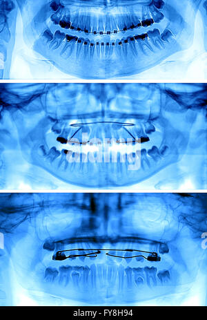 Différents appareils orthodontiques fixes et amovibles : Banque D'Images