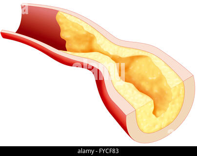 L'athérome, dessin Banque D'Images