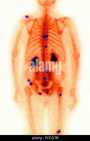 Métastase, SCINTISCAN Banque D'Images